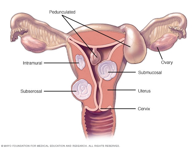 Different types of uterine fibroids and their locations