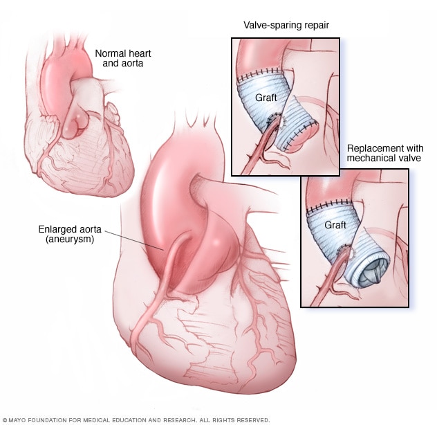 Ascending aortic root aneurysm procedure