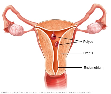 Uterine polyps