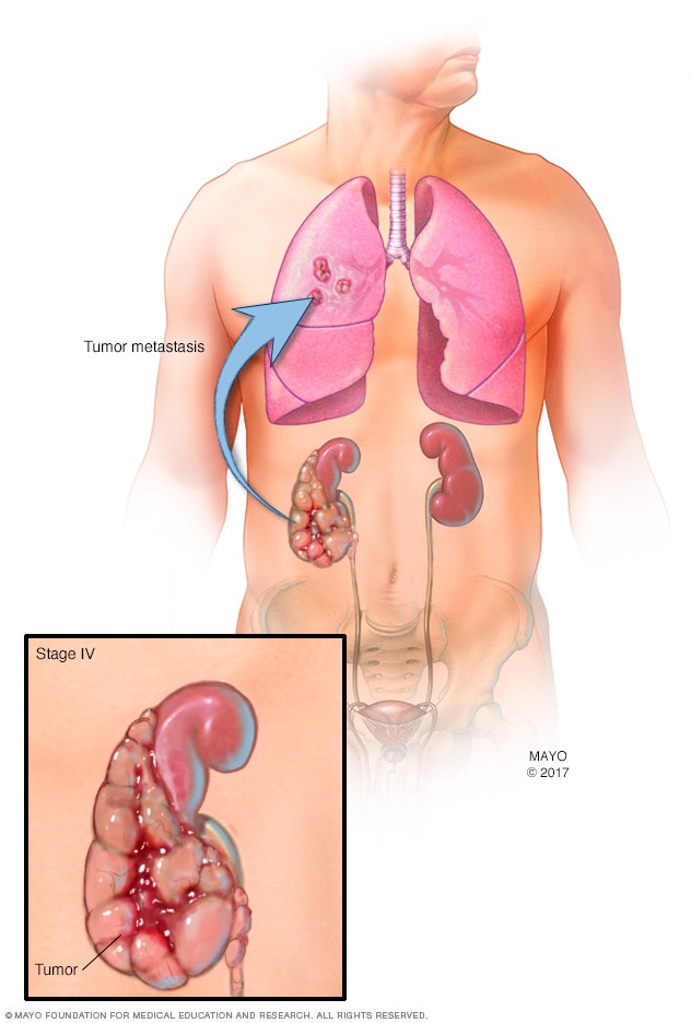 Stage IV kidney tumor