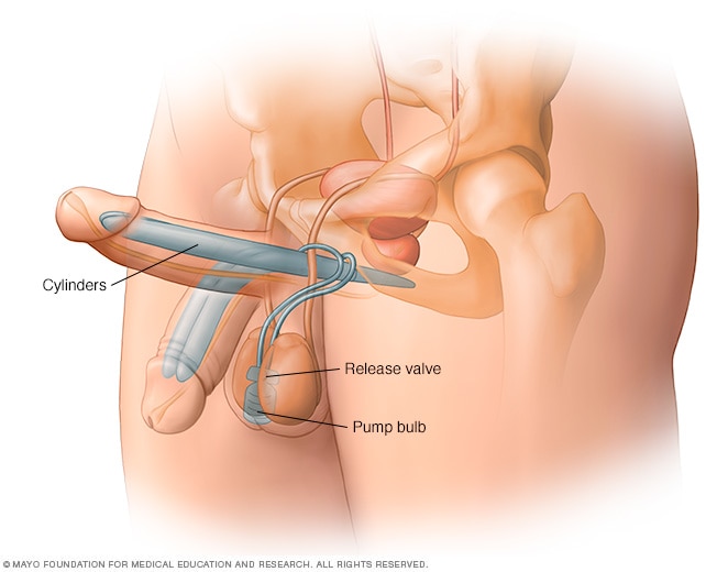 Two-piece penile implant