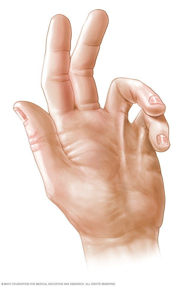 Dupuytren contracture