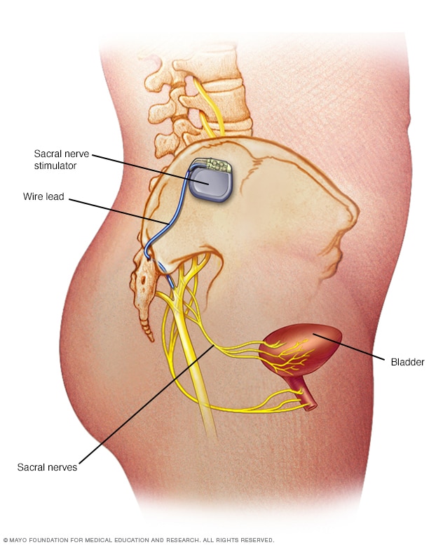 Implanted nerve stimulation device