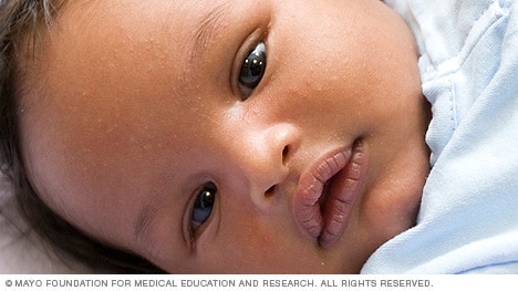 Small bumps on a newborn baby