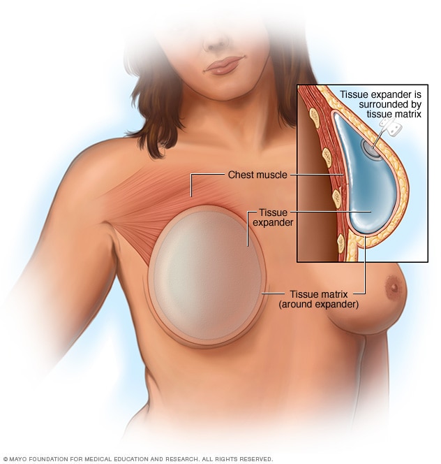 Breast reconstruction with a breast implant placed above the chest muscle