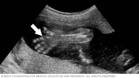 Fetal ultrasound image showing an open hand and fingers