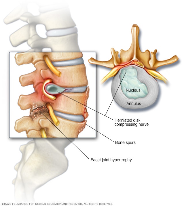 Bone spurs and herniated disk in the spine