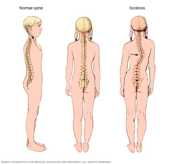 Comparing typical curves in spine with scoliosis