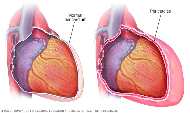 A heart with and without pericarditis