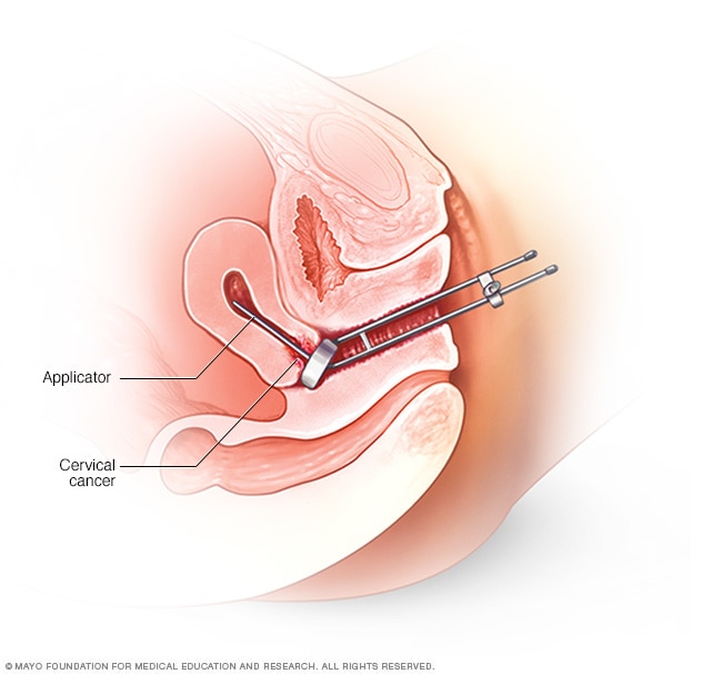 Intracavity brachytherapy