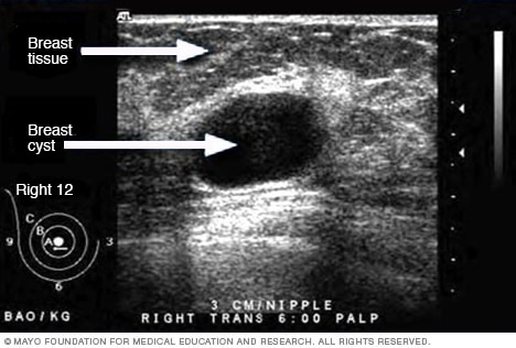 Ultrasound image of a breast cyst 
