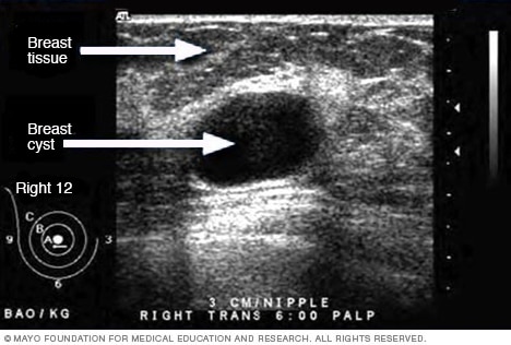 Ultrasound image of a breast cyst