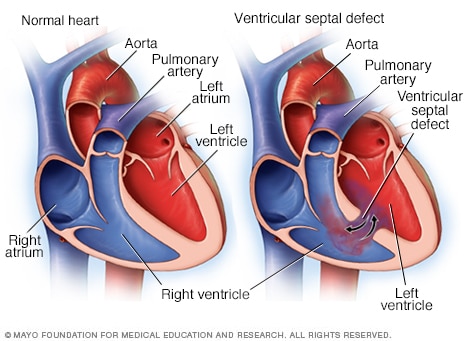 Ventricular septal defect