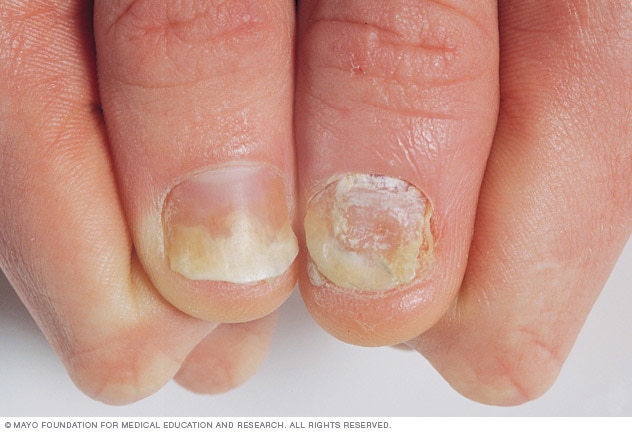 Thumbnails affected by psoriasis