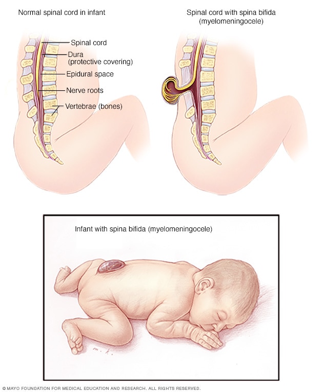 Typical spinal cord and spina bifida