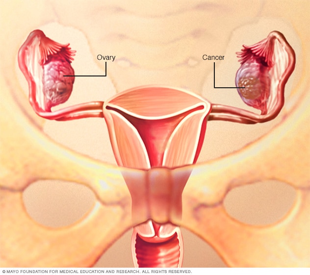 Ovarian cancer