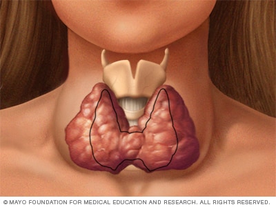 Enlarged thyroid associated with Graves