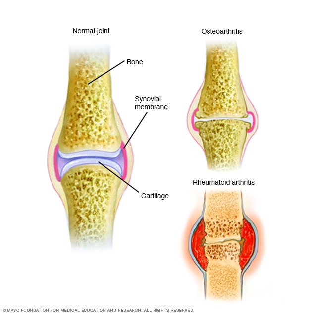 Difference between osteoarthritis and rheumatoid arthritis