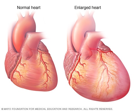 Enlarged heart, in heart failure