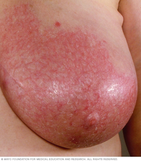 A woman with mastitis