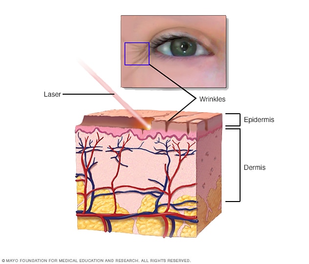 How laser resurfacing is done