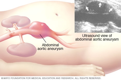 Illustration showing abdominal ultrasound of an abdominal aortic aneurysm