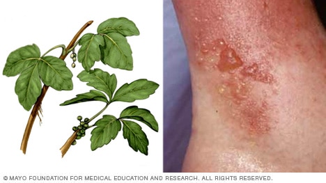 Photo of poison ivy plant and rash