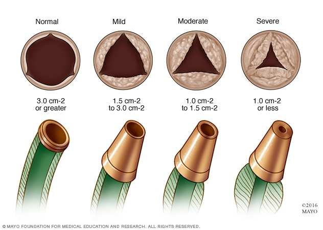 Narrowing of aortic valve in aortic valve stenosis