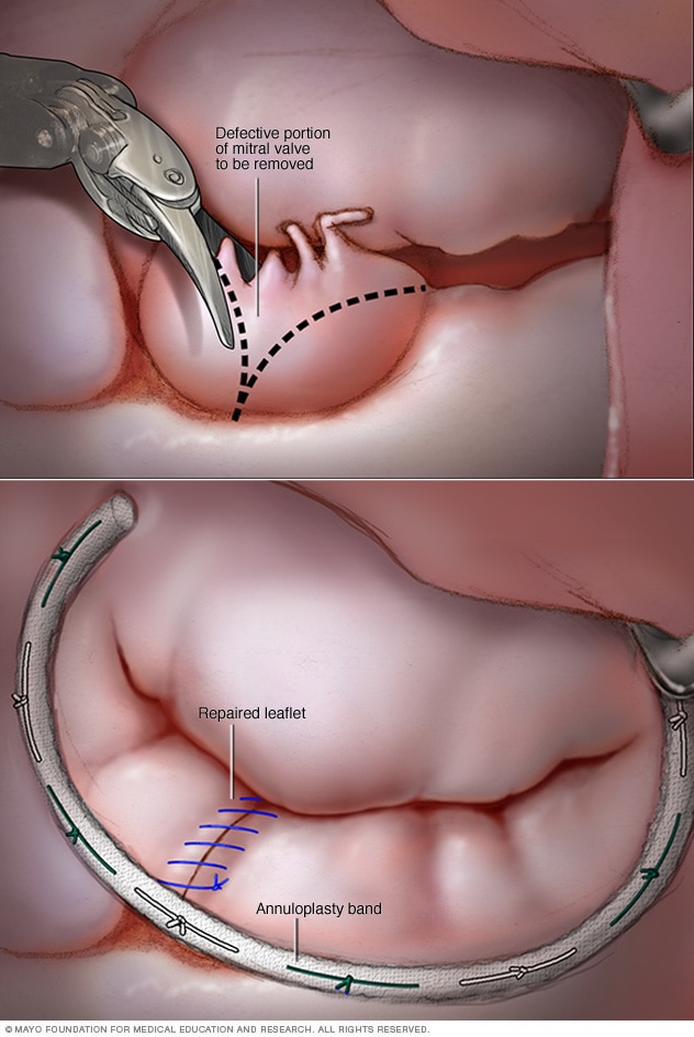 Mitral valve repair