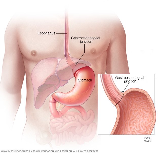 Esophagus, gastroesophageal junction and stomach