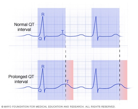 Graphs of typical and prolonged QT intervals