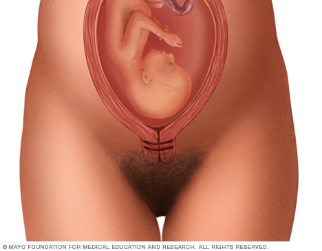 Where stitches are placed in a cervical cerclage