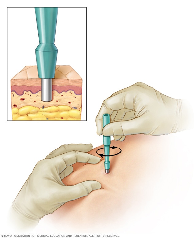 A closeup of a punch biopsy shows the layers where tissue is removed. A larger image shows how the tool is placed against the skin and twisted in.