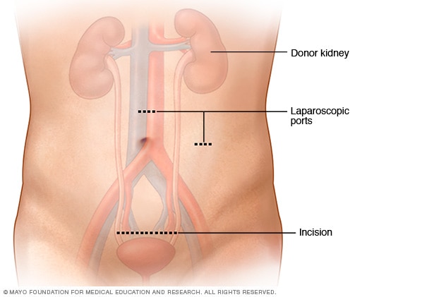 Donor nephrectomy