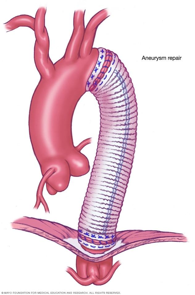 Open surgery for thoracic aortic aneurysm