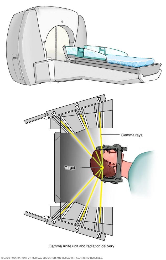 Gamma rays delivering radiation to the head.