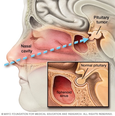 Endoscopic transnasal transsphenoidal surgery