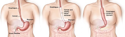 Esophageal_Cancer_resized3