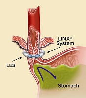 Figure Drawing of a LINX system placed on esophagus