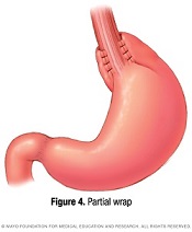 Figure of a Partial Wrap - Myotomy