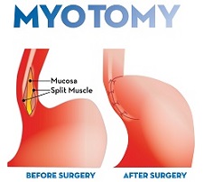 Figure of Myotomy surgery