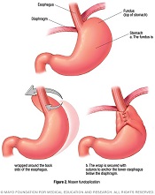 Figure of a Nissen fundoplication