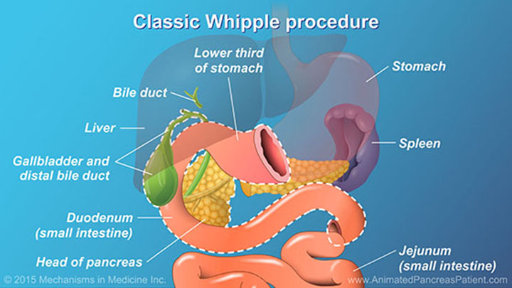 AnimatedPancreasPatient.com-understanding-pancreatic-surgery-ch13_slide_08