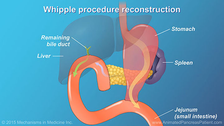 AnimatedPancreasPatient.com-understanding-pancreatic-surgery-ch13_slide_10