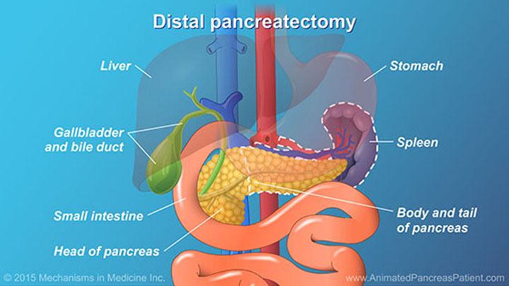 AnimatedPancreasPatient.com-understanding-pancreatic-surgery-ch13_slide_12