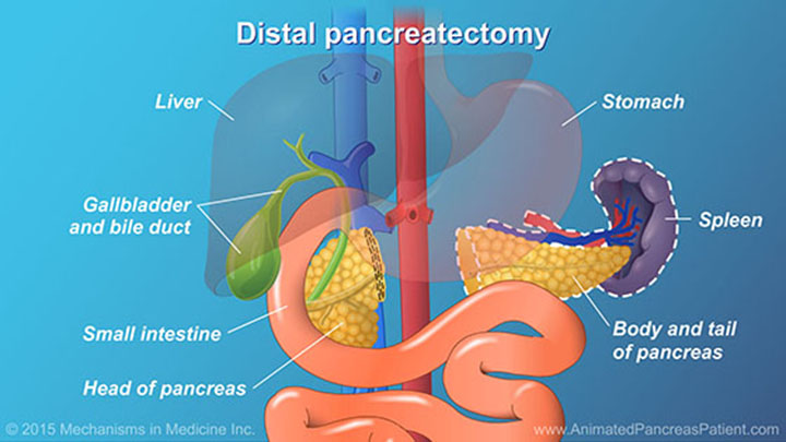 AnimatedPancreasPatient.com-understanding-pancreatic-surgery-ch13_slide_13